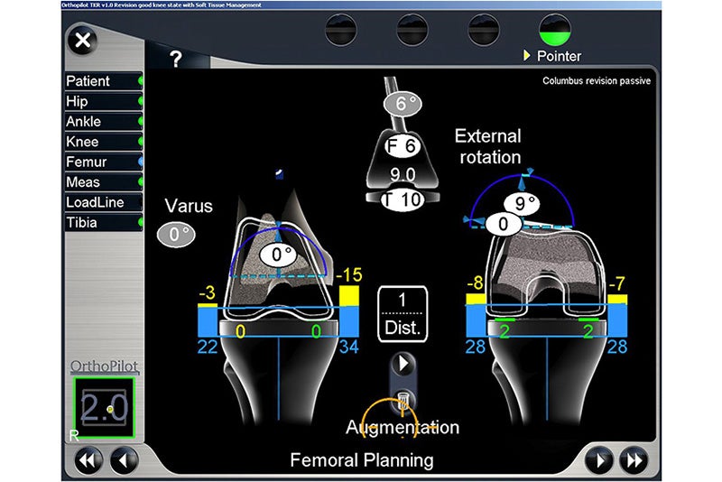 Femoral Planning