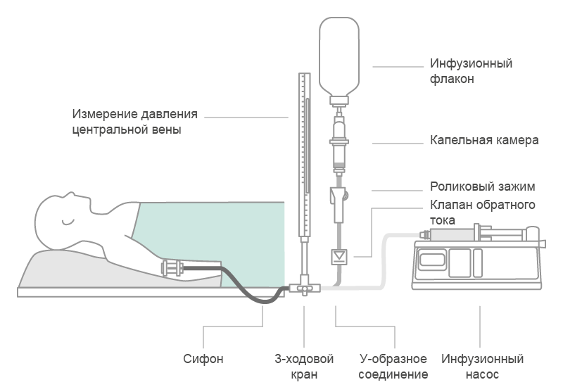 Scheme of a parallel infusion configuration. Combinations of gravity infusion and pump driven infusion in parallel bears the risk of air embolism, when gravity infusion runs dry.