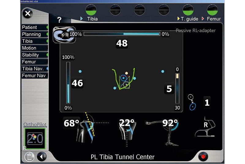 PL Tibia Tunnel Center