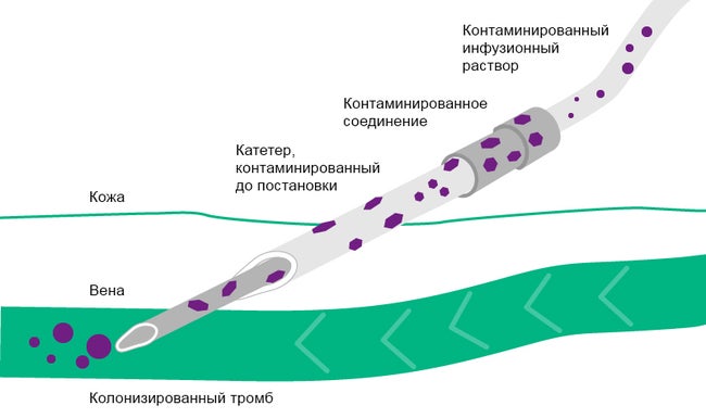 Illustration of Extra- and intraluminal route of contamination using a contaminated catheter.