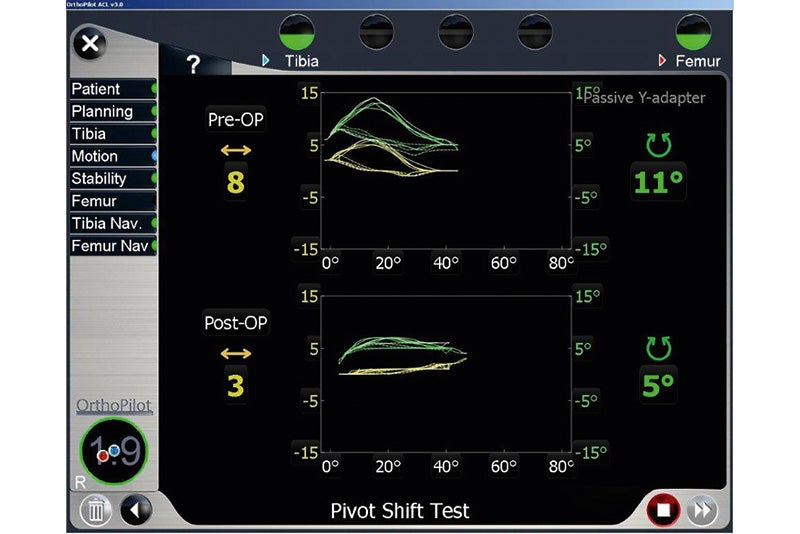 Pivot Shift Test