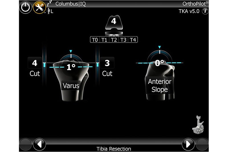 Tibia Resection