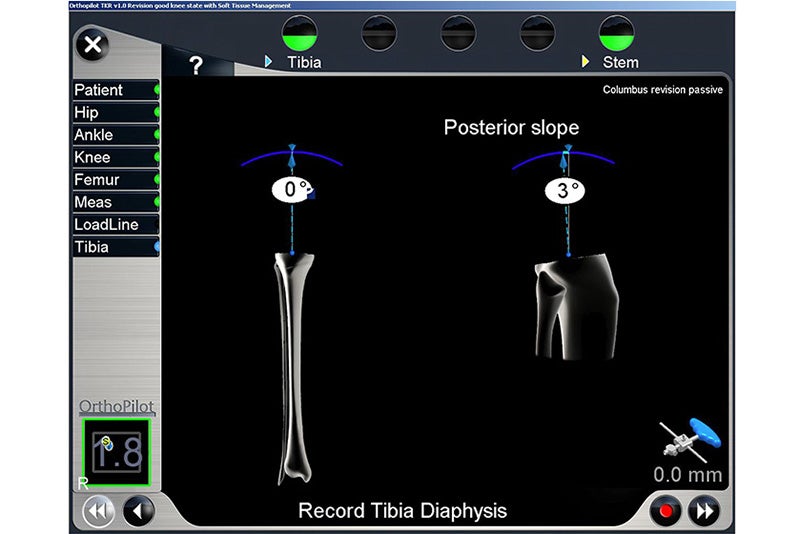 Record Tibia Diaphysis