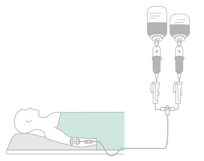 Parallel infusion with in-line filter.