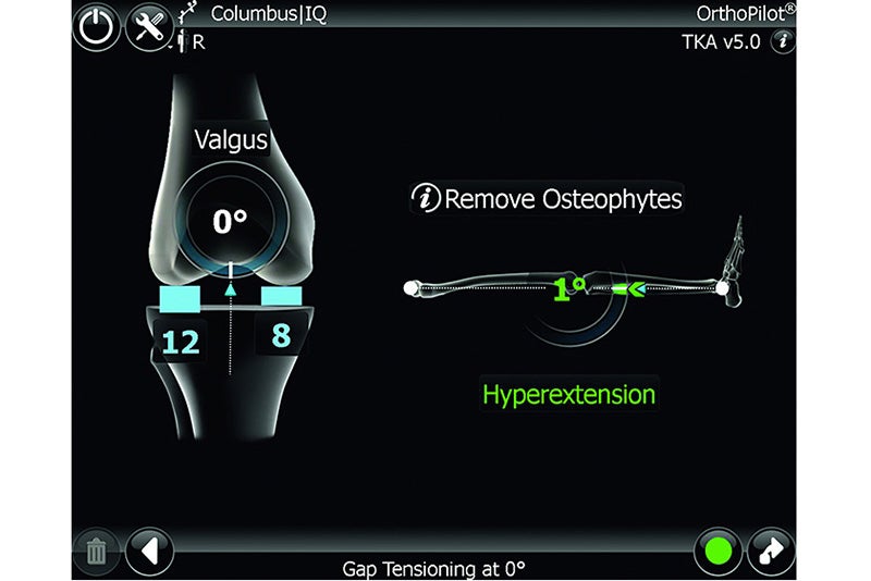 Gap Tensioning at 0°